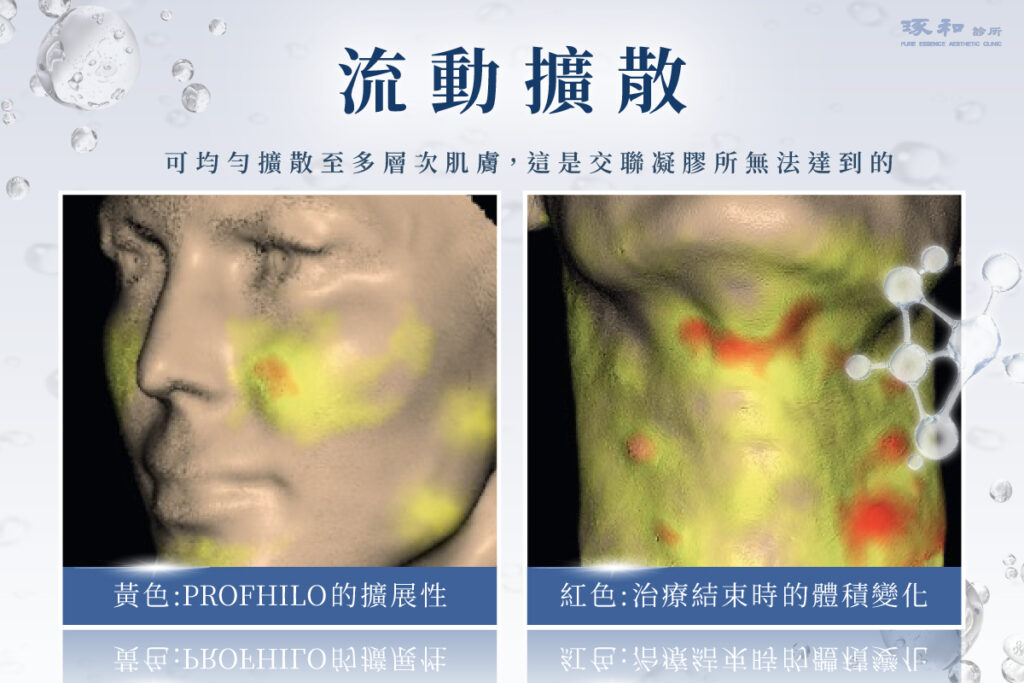 Profhilo 逆時針肌膚療程前後比較圖,黃色為 Profhilo 擴散,紅色為玻尿酸累積