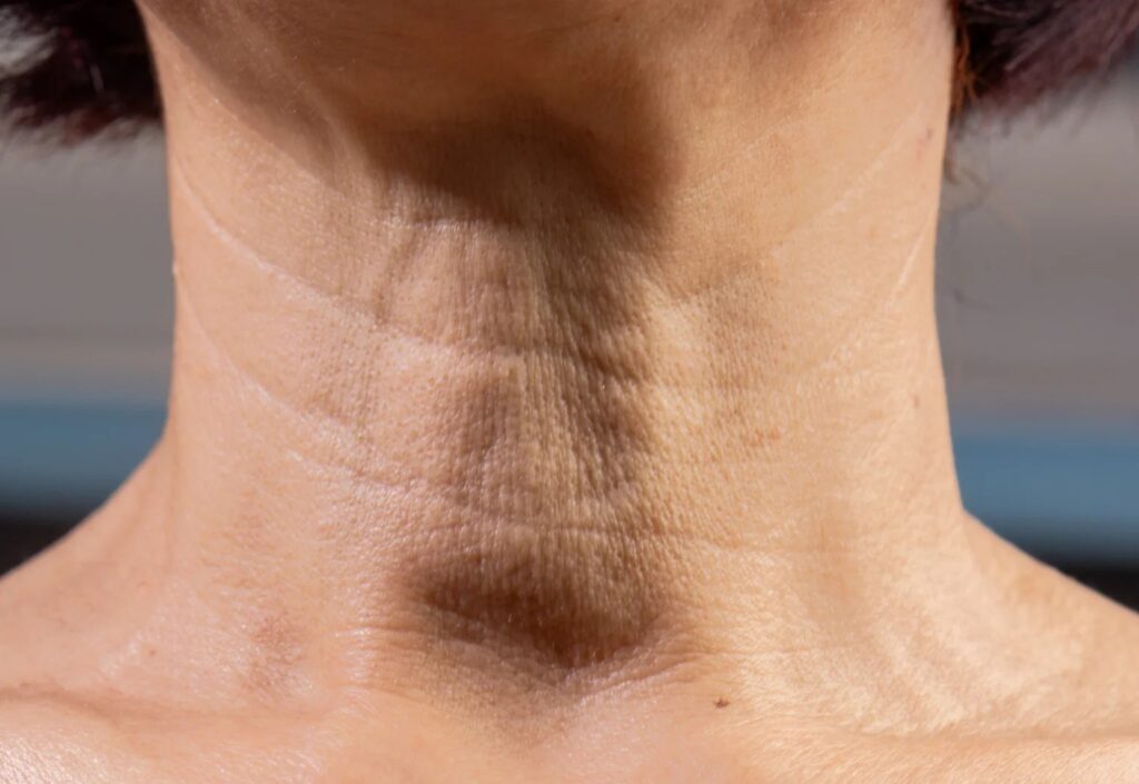 頸部皺紋特寫,顯示頸紋老化跡象。頸紋怎麼辦?