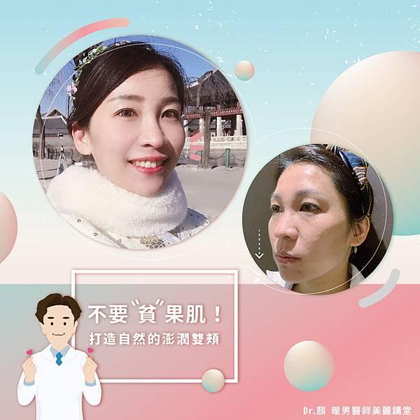 醫美填充改善蘋果肌凹陷術前術後對比。