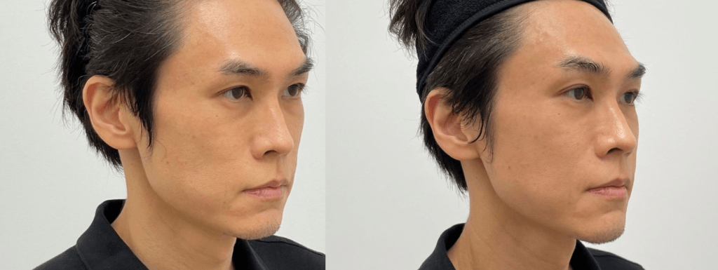 男士臉部輪廓圖前後對比,展示非手術拉皮手術的效果。建議考慮Ultherapy或Thermage。